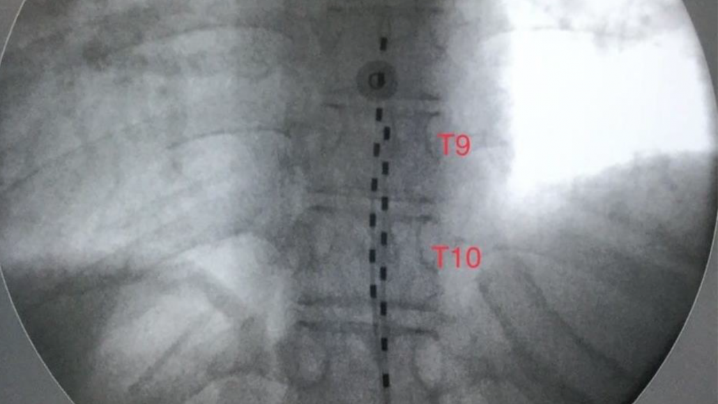 Estimulación de 10KHz para dolor lumbar